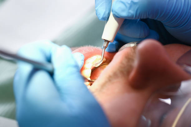 Best Emergency Treatment for Dental Infections or Abscesses in North Webster, IN
