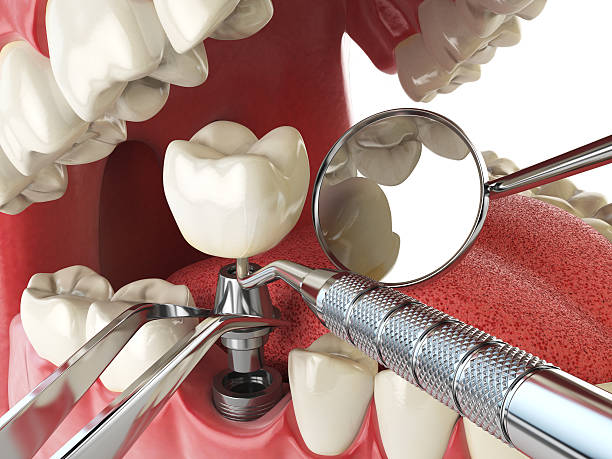 Best Emergency Tooth Extraction in North Webster, IN
